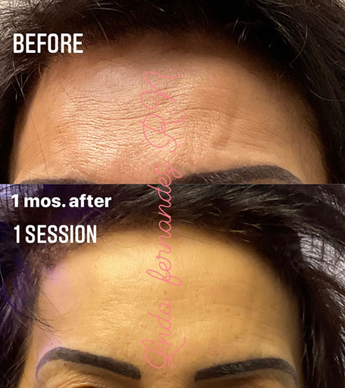 PRP Therapy Skin Before and After