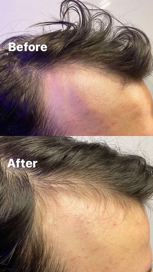 PRP Therapy Hair Before and After